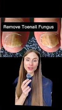 How to ACTUALLY Get Rid of Toenail Fungus #dermatologistadvice