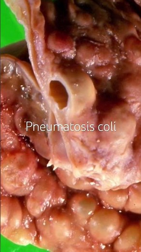 The Gross Appearance of Pneumatosis Coli - Pathology #shorts