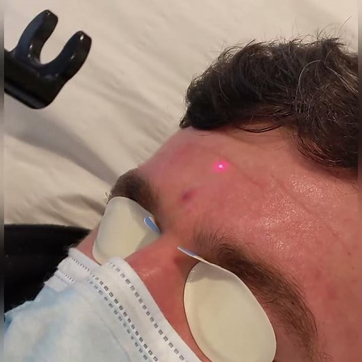 Laser Thread Vein/Angioma Removal - Instant Results