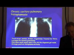 Diagnosis and treatment of chronic pulmonary aspergillosis