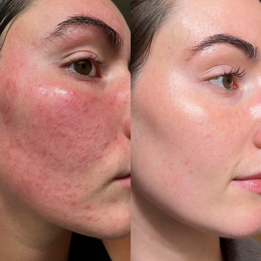 Effective Routine for Treating Demodex with Ivermectin