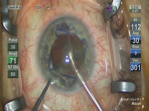 Iris Expansion Devices for Intraocular Surgery - Eyetube