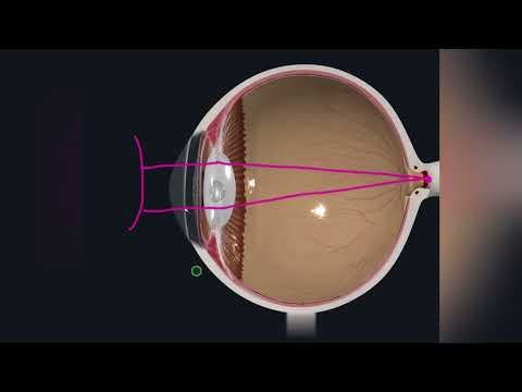 Common Eye Conditions: Myopia, Hyperopia, Astigmatism, and Presbyopia Explained