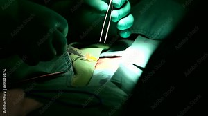 Surgeon injecting anesthesia to an open wound