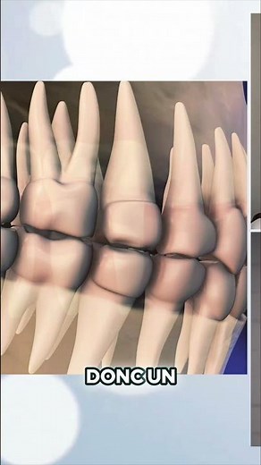 Dents de sagesse à moitié sorties: Pourquoi l'extraction est cruciale!