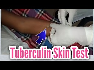 Tuberculin Skin Test or Mantoux test procedure and interpretation || PPD test