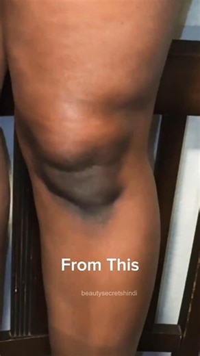 Get Whiten of Dark Knees 😱 Dark Knees Whitening Naturally at Home #Darkness #Skincare #skin