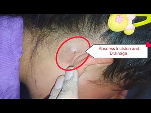 Post-Auricular Abscess | Incision and Drainage Procedure