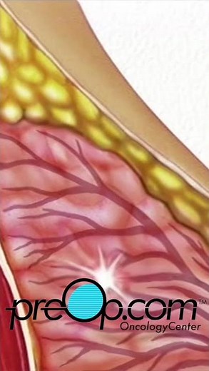 🔍 PreOp® Needle Biopsy Breast 💡 Master Key Steps Quickly ✨ #shorts