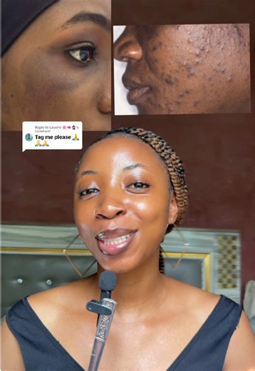 How to Treat Hyperpigmentation, Sunburn & Dark Spots on Face
