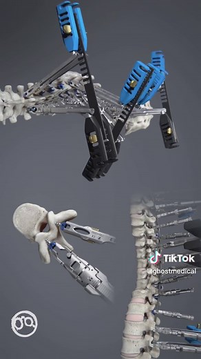 ZimVie Spine’s Polaris Deformity Spinal Fixation System