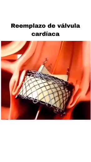 El reemplazo de válvula cardíaca transcatéter (TAVI o TAVR) es un procedimiento mínimamente invasivo que se utiliza cuando una válvula del corazón, como la aórtica, está dañada y no permite el flujo adecuado de sangre. En lugar de abrir el pecho en una cirugía mayor, los médicos introducen un catéter por una arteria, generalmente en la pierna, y llevan hasta el corazón una nueva válvula biológica montada sobre una malla metálica. Una vez en posición, esta válvula se despliega dentro de la que es