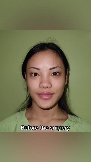Real People, Real Results: Icon Doll Top Surgery Before and After
