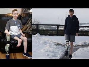 15-Year-Old Gets Foot Re-Attached Backwards After Leg Is Amputated From Cancer