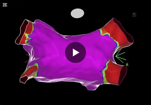 AFib Ablation with PFA in Left Atrium using Carto3 | Javier Vargas Díaz posted on the topic | LinkedIn