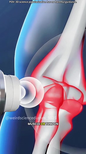 Exploring Shockwave Therapy: A 3D Animation Guide