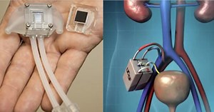 The World’s First Artificial Kidney Is Going To Replace Dialysis In The Next Few Years. This Is How It Works!