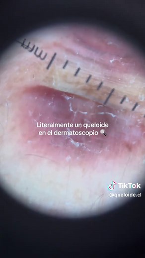 Tratamientos para queloides: mitos y realidades