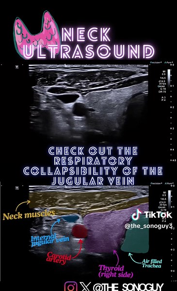 Understanding Neck Ultrasound Scans: A Comprehensive Guide