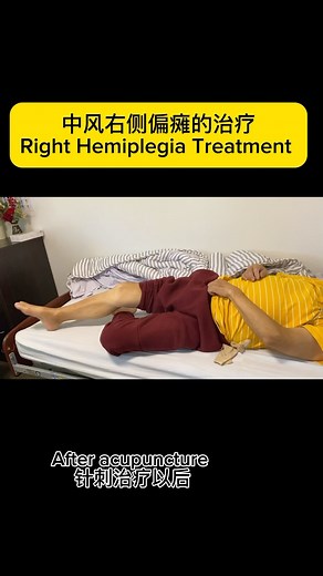 中风右侧偏瘫的治疗 Right Hemiplegia Treatment 期待潘世南医师的中文公益课 | 中医针灸学校-小潘医师 Szenan Phua