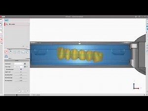 ApexMill (Labial Side Milling Setting)