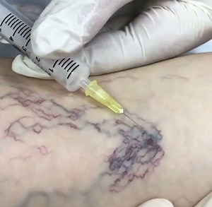 Spider veins (telangiectasias) disappearing almost immediately