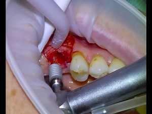 [19] Live Dental Implant Surgery
