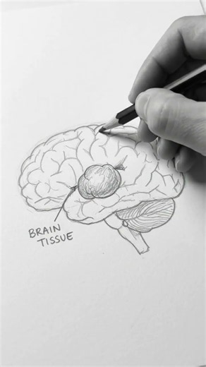 What Is a Meningioma? 🧠 | Brain Tumor Explained
