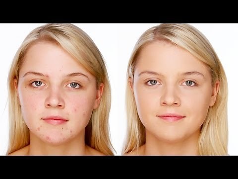 Acne/Blemish Covering Makeup - My Pinpoint Concealer Technique