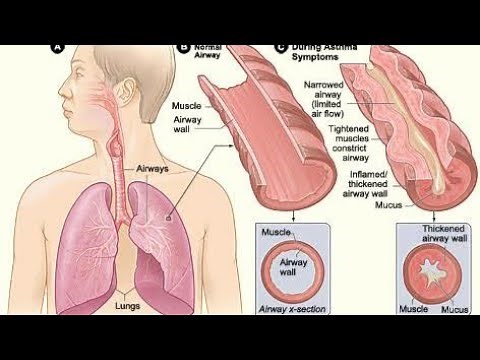 bronchial asthma