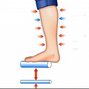 This video shows how compression stockings help flatten varicose veins, thereby reducing blood pooling and reducing inflammation in the vein wall. This reduces pain, throbbing and swelling in the lower extremity. #varicoseveins #compressionstockings @venasmart VenaSmart.com for high quality compression stockings that are made in the USA | Vein Treatment Center