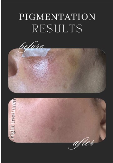 Pigmentation doesn't stand a chance against the right treatment! ✨ Watching dark spots, melasma, and uneven tone fade away never gets old. These results show what's possible when you stop covering up pigmentation and actually treat it. Stop hiding behind filters and foundation. Let's fix what's underneath. Ready to fade your pigmentation? Book your appointment. 📍 I-8, Islamabad 📞 0311-4924446 #Pigmentation #MelasmaHealsFree #DarkSpots #AyeshasAesthetic #IslamabadSkincare pigmentation treatment