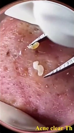 How to Removal Blackheads & Whiteheads on Face at home #𝑨cneClearTh #Extraction #Porecleansing