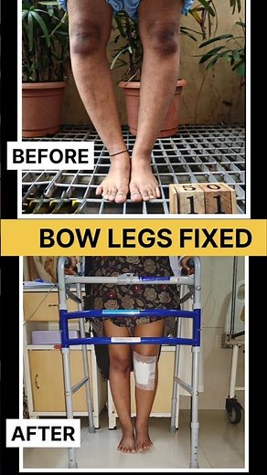 HTO (High tibial osteotomy) bow legs fixed in 56 days #bowlegs