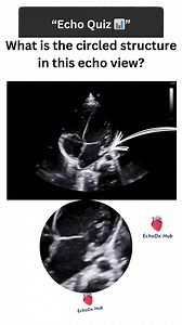 “Echo Quiz 📊” 👉 What is the circled structure in this echo view? 💬 “Doctors & Sonographers — drop your answers 👇” #EchoDxHub #Echocardiography #CardiologyQuiz #EchoTeaching #HeartImaging #CardiacSonography #EchoQuiz #CardiologyEducation #MedicalLearning #CardiologyCase | EchoDx Hub