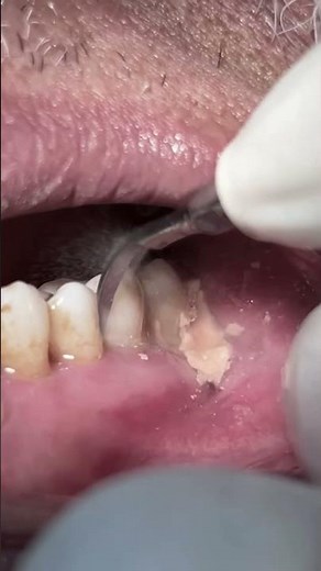 Scaling and cleaning teeth from tartar & calculus #satisfying