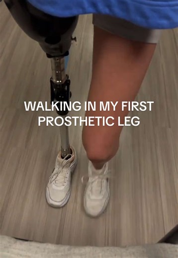 My Journey with a New Prosthetic Leg