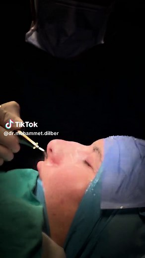 Ultrasonic Rhinoplasty: A Revolutionary Piezo Technique
