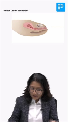 Learn Uterine Balloon Tamponade with Dr. Shonali Chandra . . #obgyn #prepsmart #medical #medicalstudy #medicalstudent #futuredoc #prepladder | PrepLadder Medical | Facebook