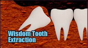 Wisdom Tooth Extraction/Third Molar Dis Impaction/Minor Oral Surgery – Richardson's Plastic Surgery Hospitals