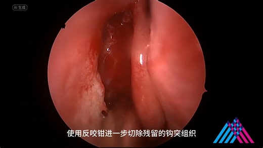 功能性内镜鼻窦手术治疗（非医学相关专业慎入）