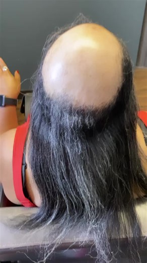 ✨ READY FOR A TRANSFORMATION? Stop waiting — Get your hair done NOW & Pay Later! 💳 We proudly accept Affirm, Afterpay & Klarna so you can slay today and pay your way. 🚨 ALOPECIA NEVER WINS‼️ Struggling with hair loss? You’re NOT alone — and we CAN help. 📩 DM the word “ALOPECIA” for your FREE private consult. 📆 Calendar is NOW OPEN for bookings — secure your spot before it’s gone! 📍 Dallas, TX (Duncanville) — Appointments are filling FAST 🔥 🎓 Want to learn & earn? Start your journey today!