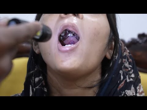 Anterior Maxillary Distraction (AMD) in a Girl | Few Months Post-Surgery Result