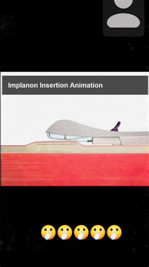 🩺 Mini-Cours Infirmier: Insertion de l’Implanon NXT® 📌 Objectif Informer les professionnels de santé sur les étapes clés, les précautions et les bonnes pratiques liées à l’insertion de l’implant contraceptif Implanon NXT®. 🔍 Qu’est-ce que l’Implanon NXT®? - Type: Implant contraceptif hormonal sous-cutané - Durée d’action: Jusqu’à 3 ans - Composition: Étonogestrel (progestatif) - Forme: Petit bâtonnet flexible de 4 cm inséré sous la peau du bras 🧰 Matériel nécessaire - Implanon NXT® stérile -