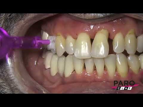 Traitement parodontal sans douleur - 1ère réévaluation et réinstrumentation locale