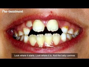 Maxillary expansion and how to retain it