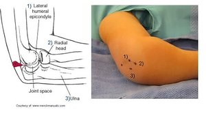 Use of Arthrograms in Pediatric Orthopaedic Surgery