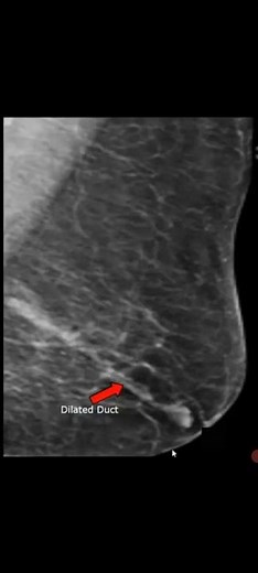 2.Ductal Ectasia of Breast Mammography@#@#Breast cancer@#@Awerenes of All@#Abnormal Breast#@radiolog