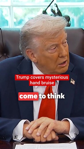President Donald Trump tried to cover a mysterious hand bruise as he signed Executive Orders in front of the media. He flashed the dark patch of skin on his right hand when he pointed out the World Cup trophy in the Oval Office. | The Independent