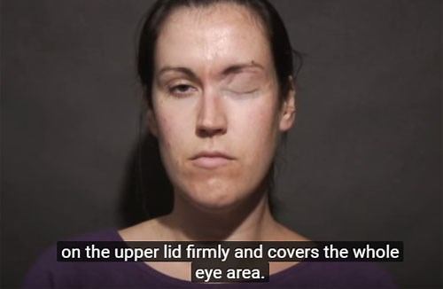 Eye taping - Facial Palsy UK